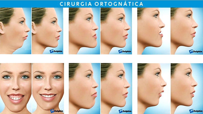 Casos indicados para cirugia ortognática